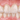 Are Zirconia Veneers the Next Step in Aesthetic Dentistry? - Elegant Dental Laboratory