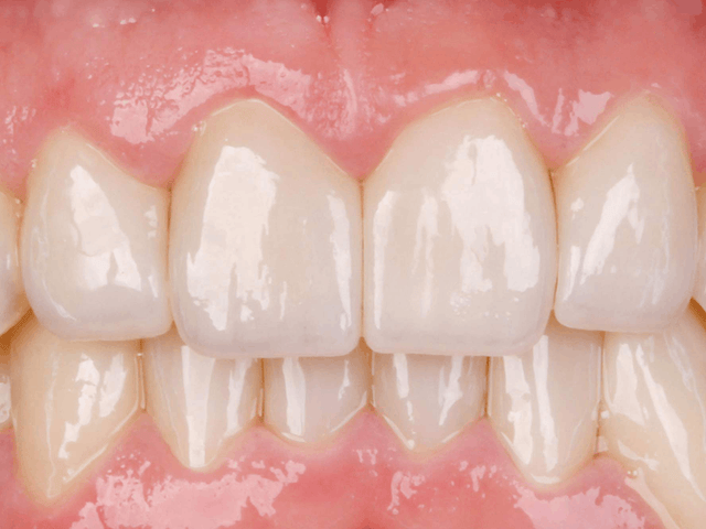 Are Zirconia Veneers the Next Step in Aesthetic Dentistry? - Elegant Dental Laboratory