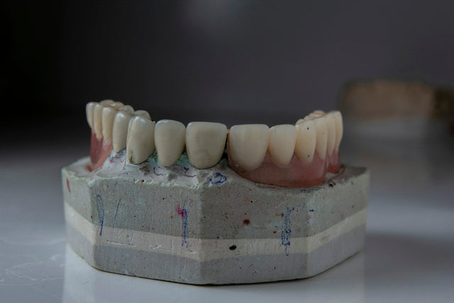 Crowns on a stone model of a dental arch