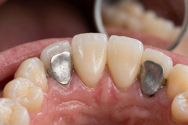 Maryland bridge with metal wings bonded to the back of the front teeth, seen with a dental mirror