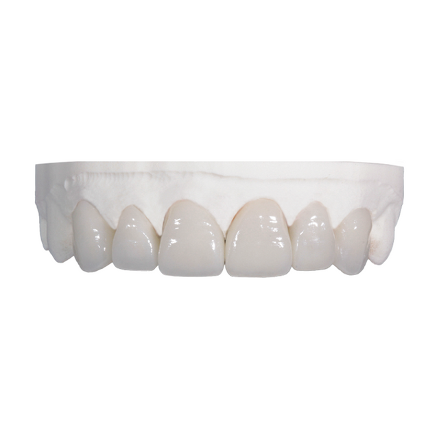 IPS e.max veneers on a stone model