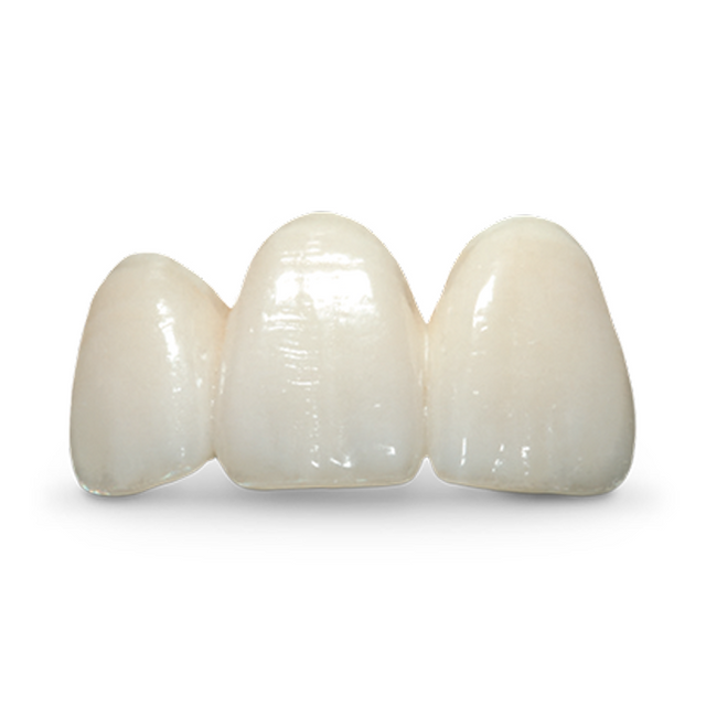 IPS e.max layered anterior crowns