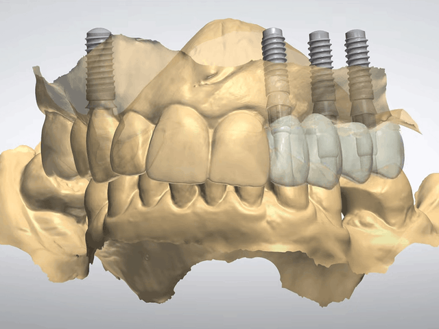 Digital design of an implant bridge on a virtual model