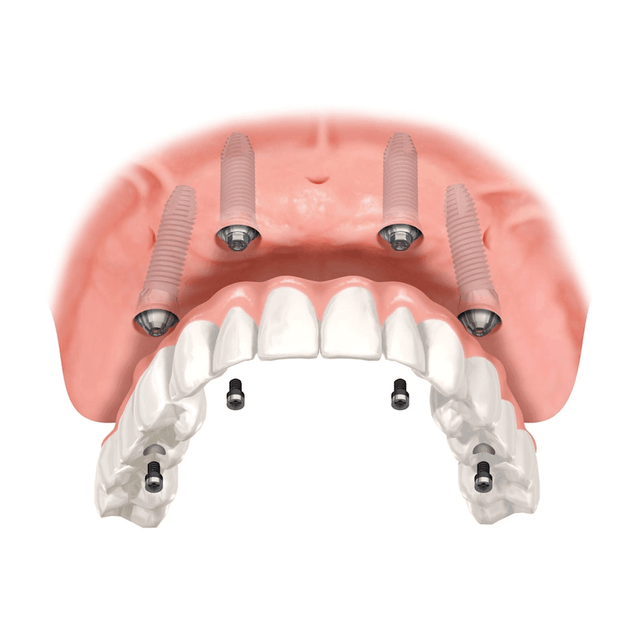 Full-arch implant prosthesis designed for four implants, made in our Brooklyn lab