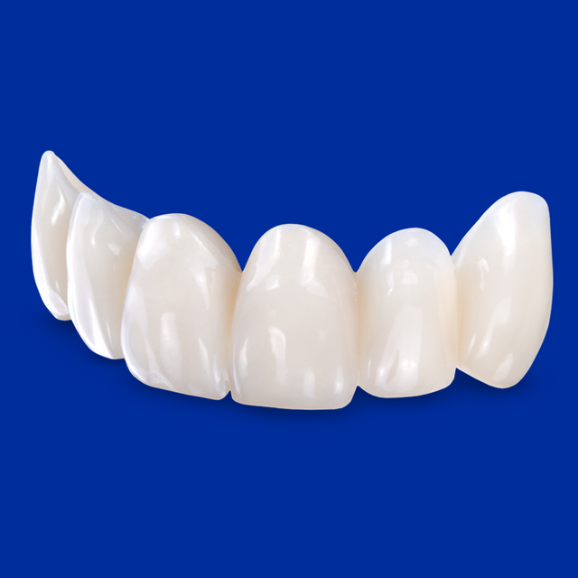 Provisional anterior bridge