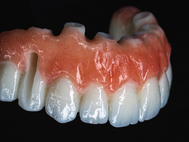 Full-arch provisional restoration with pink gingival shading
