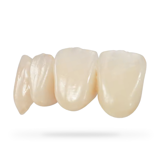 Solid zirconia crowns with buccal porcelain