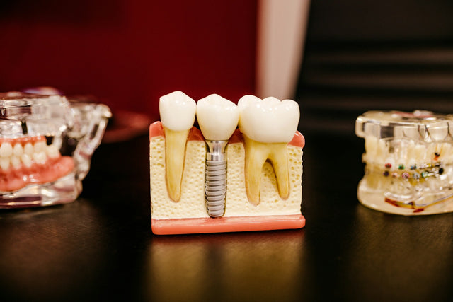 Dental implant models with crowns on a table