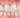Are Zirconia Veneers the Next Step in Aesthetic Dentistry? - Elegant Dental Laboratory