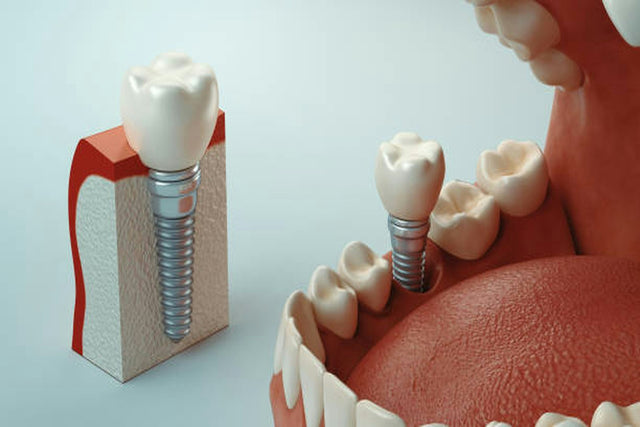 Model of a dental implant with its crown, shown in the jaw