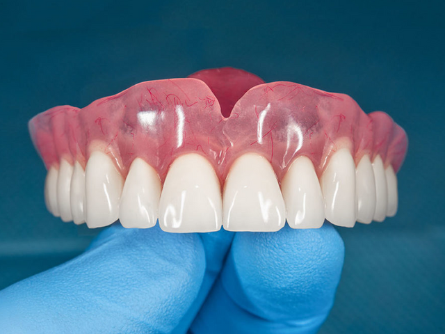 Upper complete denture with natural-looking anterior teeth, made in our Brooklyn lab