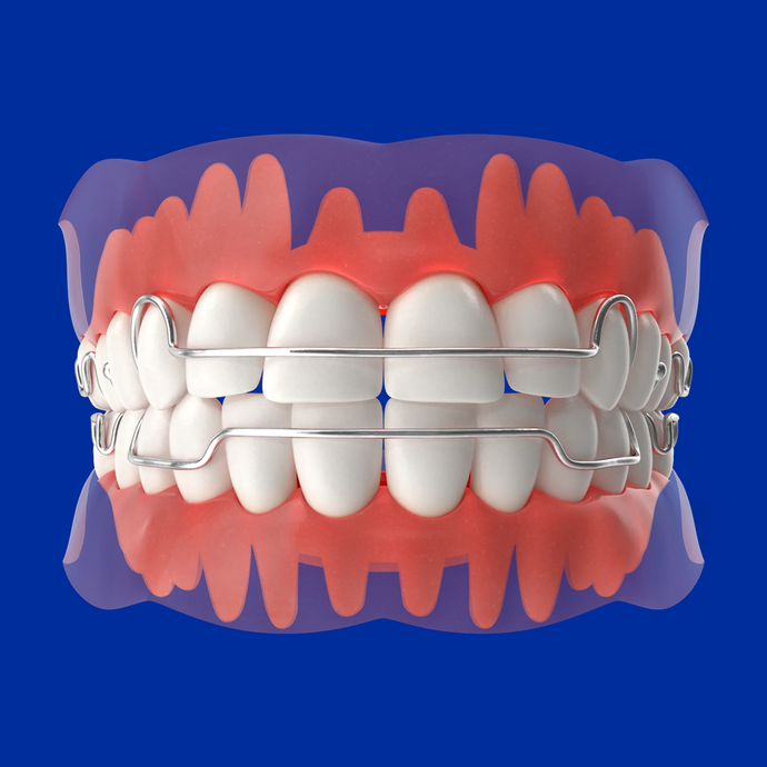 Orthodontic appliance with labial wire on a 3D dental model