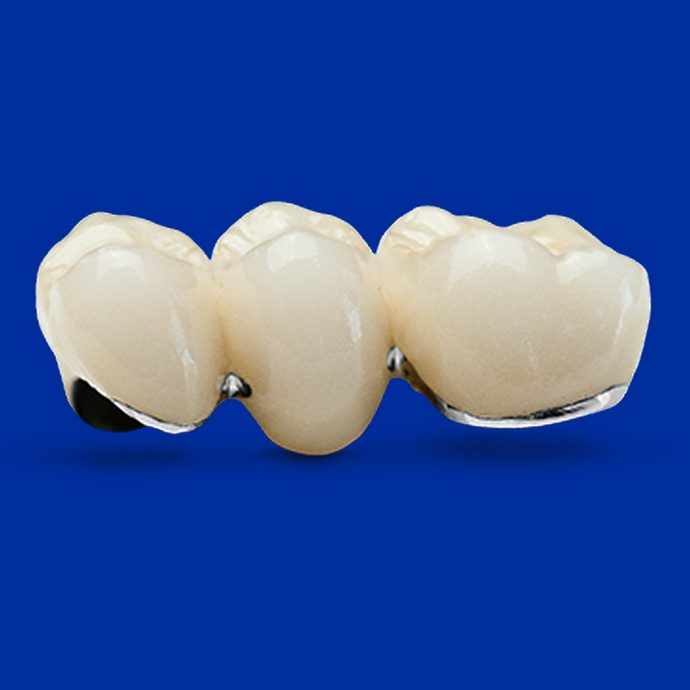 Three-unit PFM bridge