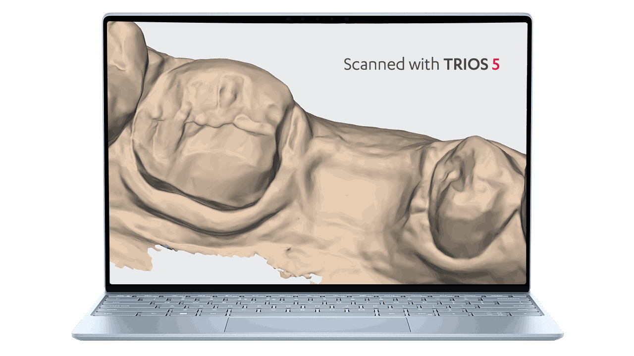 3D dental model on laptop